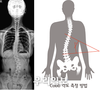Cobb 각도 측정방법ⓒ인천성모병원