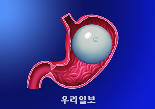 내시경을 통해 위 속에 설치된 의료용 풍선 ⓒ순천향대학교 부천병원