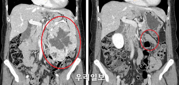 (좌) 21cm까지 커진 신장암으로 모양이 변형된 홍 씨의 신장 CT, (우) 로봇수술로 신장암 제거 3개월 후 정상 모습으로 회복된 홍 씨의 신장 CT 사진 ⓒ 순천향대 부천병원 제공